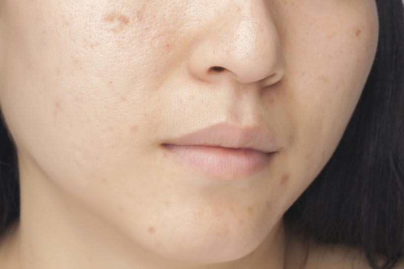 Hyperpigmentation | Uptown Medical Wellness Center